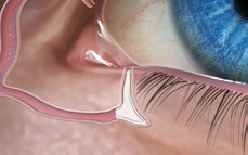 FORM FIT® Punctum Plug 
