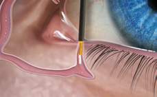 FORM FIT® Punctum Plug 